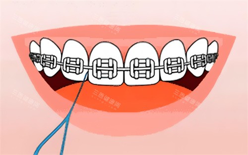 金属牙齿矫正卡通图片 金属牙齿矫正卡通图片