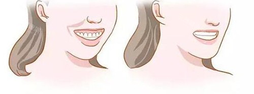 牙齿矫正脸型变化对比漫画图 牙齿矫正脸型变化对比漫画图