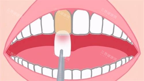 牙齿贴面动画示意图 牙齿贴面动画示意图