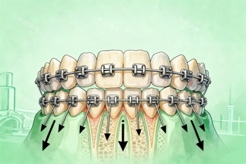 牙齿矫正模型图片展示 牙齿矫正模型图片展示
