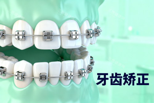 传统牙齿矫正方式展示 传统牙齿矫正方式展示