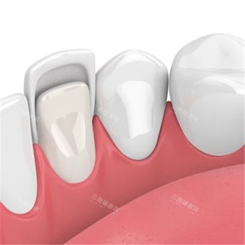 牙齿贴面内侧 牙齿贴面内侧