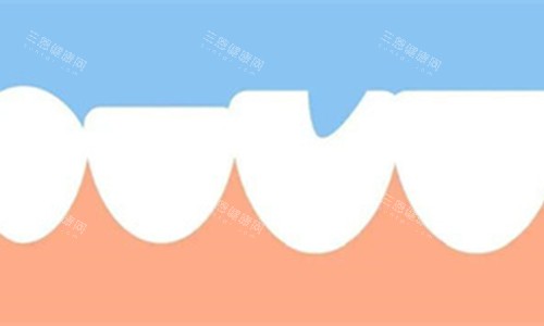 牙齿缺失一块展示图 牙齿缺失一块展示图