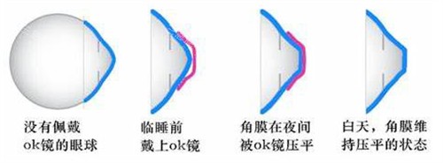 角膜塑形镜多少钱 角膜塑形镜多少钱