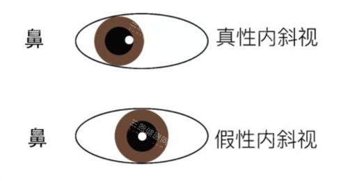 爱尔眼科治疗小儿和成人斜视技术怎么样？医师团队、手术方案及结果真实分享！