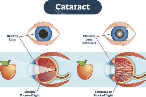 汕头2025年免费白内障手术政策全解析：申请条件、流程与定点医院指南