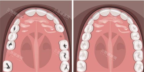 牙齿缺失补牙示意图
