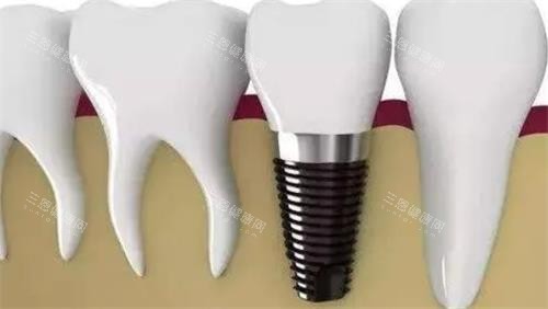 重磅！南方医科大学口腔医院种植牙价格表计划更新，6大院区统一价5800起，种植体+牙冠打包价更划算