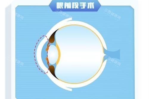 2026深圳市人民医院眼科收费详情表：全飞秒/OK镜/验光/白内障/眼底病等费用无套路还部分报销