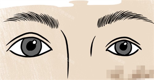 双眼皮大小眼修复