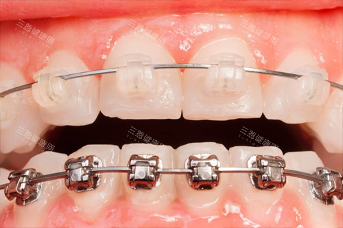 陶瓷自锁矫正器和金属自锁矫正展示 陶瓷自锁矫正器和金属自锁矫正展示