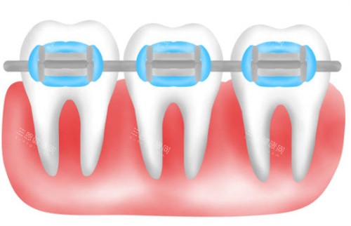 自锁矫正卡通图 自锁矫正卡通图