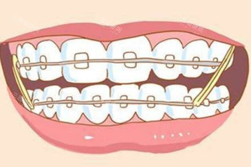 牙齿矫正卡通图片展示