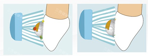 牙齿矫正OBrace球面托槽清洁侧面图