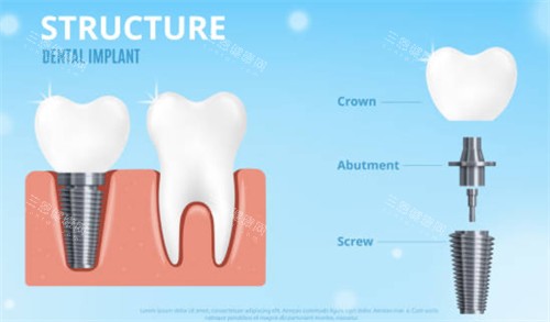 2026种牙选什么品牌？10大热门种植体特点，性价比与稳定性参考