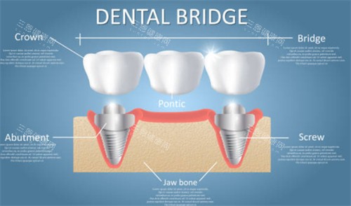 种植牙连桥冠示意图 种植牙连桥冠示意图