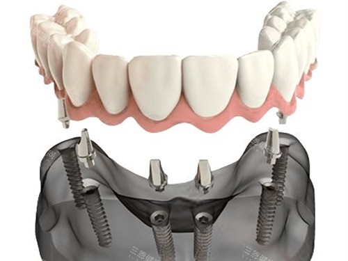 合肥种植牙价格表2026一览，单颗1680元起，超详细国产|进口种植牙价格参考