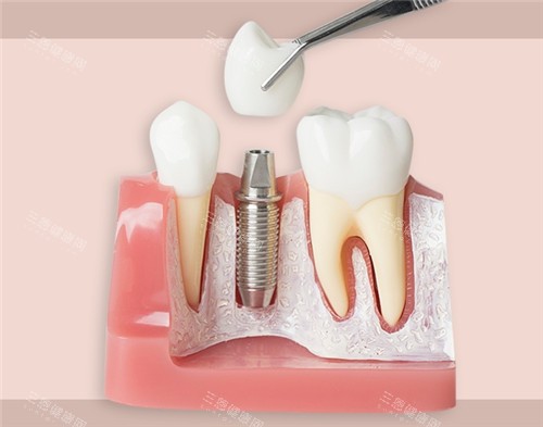 种植牙模具图片