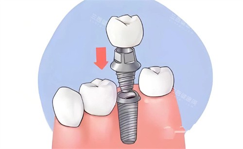2026维乐口腔种植牙收费明细！单颗/半口/全口价格公开，真实患者体验大揭秘