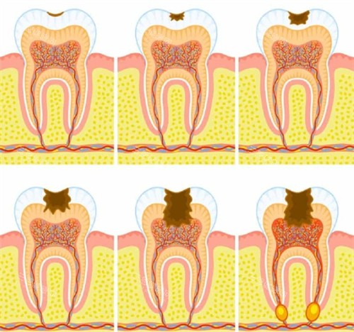 需要根管治疗的牙齿