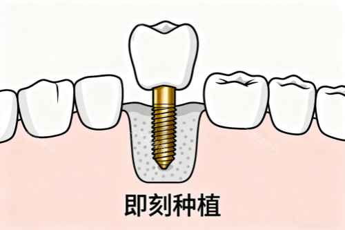 牙齿即刻种植卡通图