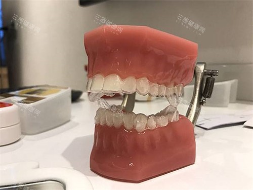 隐形牙齿矫正牙套模型