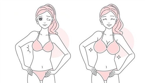 隆胸手术前后 隆胸手术前后