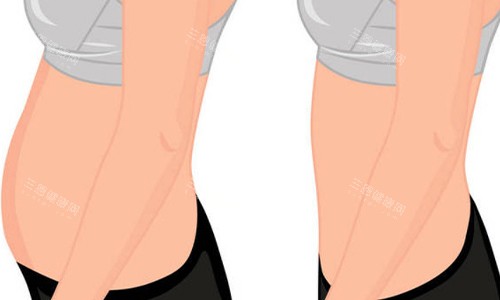 腰腹环吸前后对比图