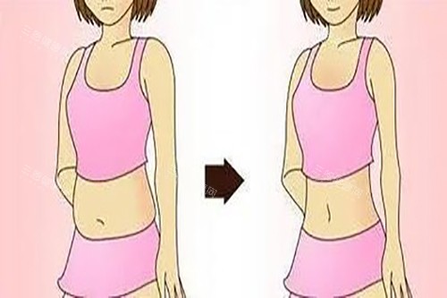 腰腹吸脂示意图卡通