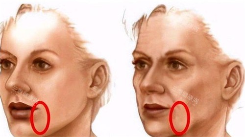 口角囊袋展示图