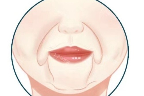 口角囊袋卡通图