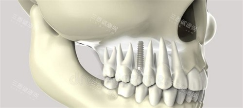 种植牙动画图示展示 种植牙动画图示展示
