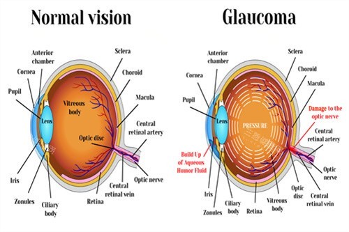 正常与青光眼对比