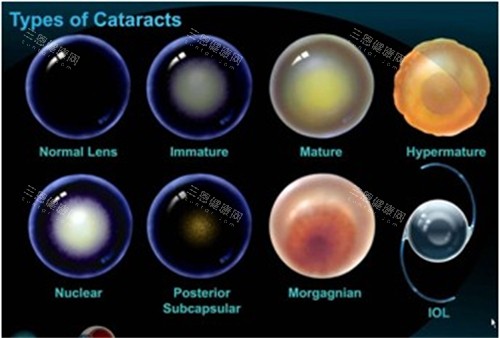 山东省立医院眼科2026价格表:近视眼1万元起、白内障8000元起、斜视6900元起、OK镜6500元起