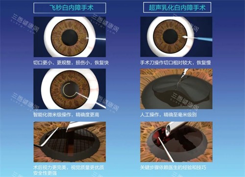 四川省人民医院白内障手术哪个医生好？3位头牌医生真实测评+术后1年视力反馈费用大公开
