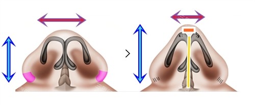 鼻翼缩小是内切好还是外切比较好？医生实测：2种术式疤痕/修养期/结果对比（附真实实例）