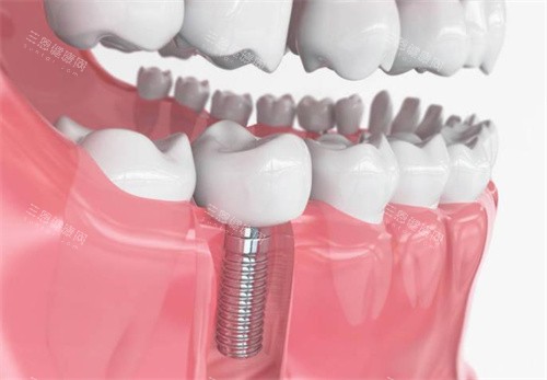 种植牙模型展示图片
