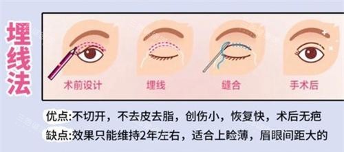 刘志刚眼修复术后三个月真实分享：肉条疤痕消失技术解析与闭眼无痕的日常护理秘诀
