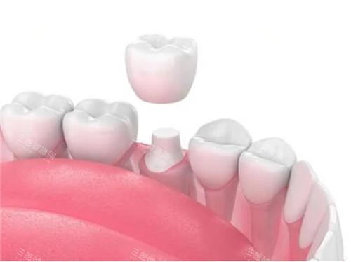 牙齿戴牙冠示意图