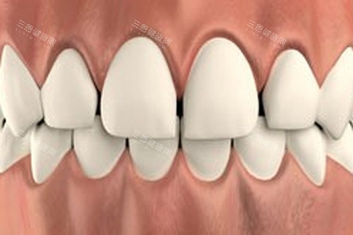 牙齿稀疏示意图 牙齿稀疏示意图